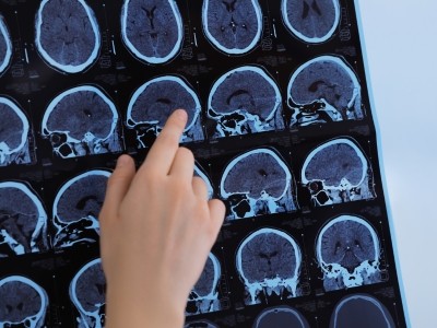 Inleiding tot Multiple Sclerose voor verpleegkundigen